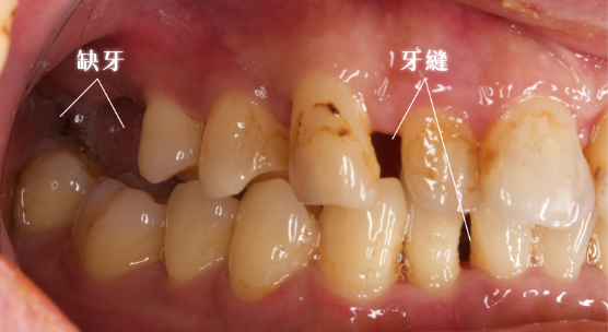 缺牙不處理會怎樣？假牙贋復專科醫師警告２大後果