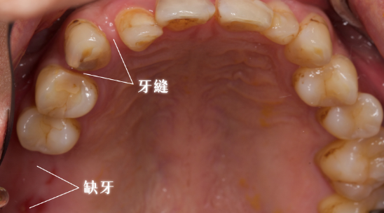 缺牙不處理會怎樣？假牙贋復專科醫師警告２大後果