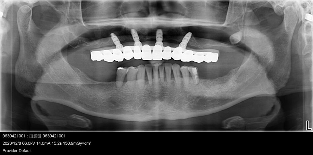 田先生 All-on-4 全口重建 案例